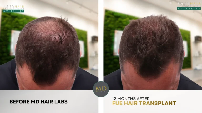 Crown hair restoration before and after — 12 months after WAW FUE hair transplant at MD Hair Labs in Rogers, AR