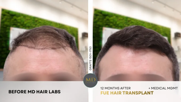 Close-up hairline restoration before and after — 12 months after FUE hair transplant with medical management at MD Hair Labs in Rogers, AR