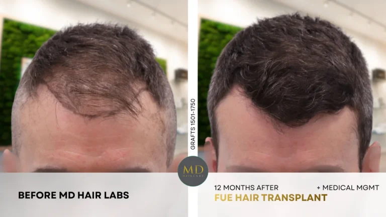Hairline and mid-scalp hair restoration before and after — 12 months after FUE hair transplant with medical management (1,501–1,750 grafts) at MD Hair Labs in Rogers, AR