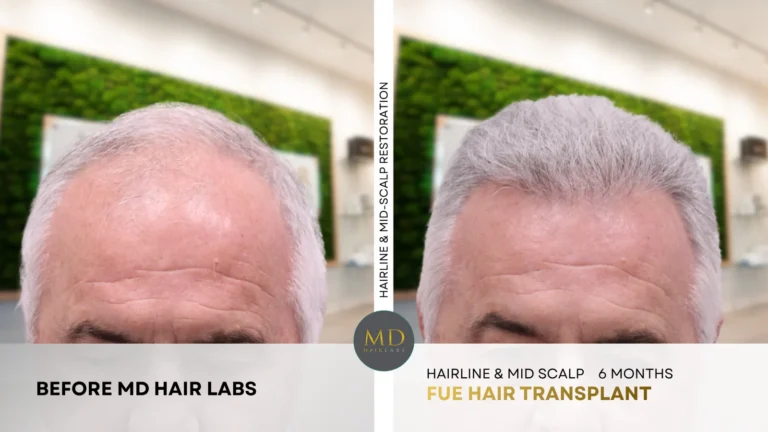 Hairline and mid-scalp hair restoration before and after — 6 months after FUE hair transplant at MD Hair Labs in Rogers, AR