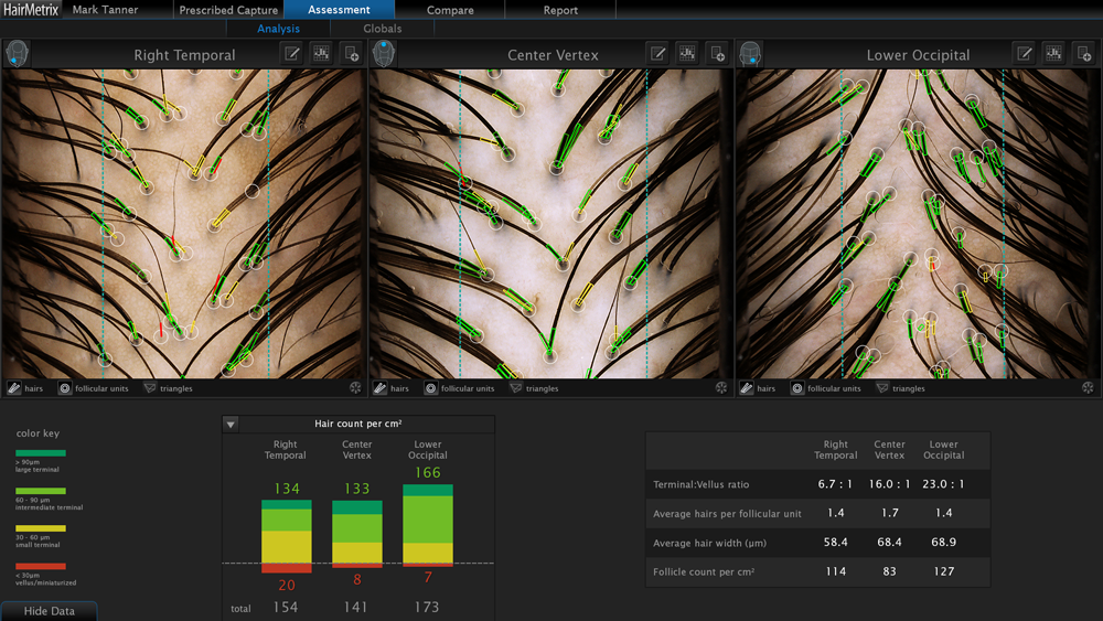 HairMetrix AI scalp analysis showing hair count per cm2, terminal-to-vellus ratio, and follicle density across three scalp zones