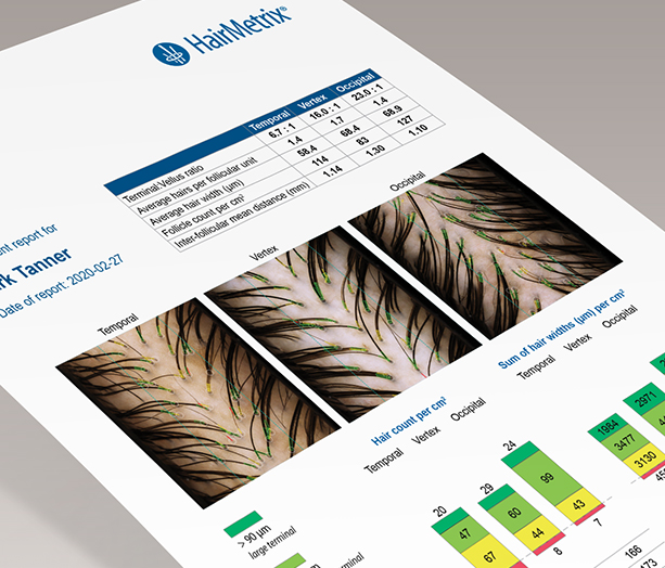 Sample HairMetrix hair-analysis report showing hair density and terminal-to-vellus data