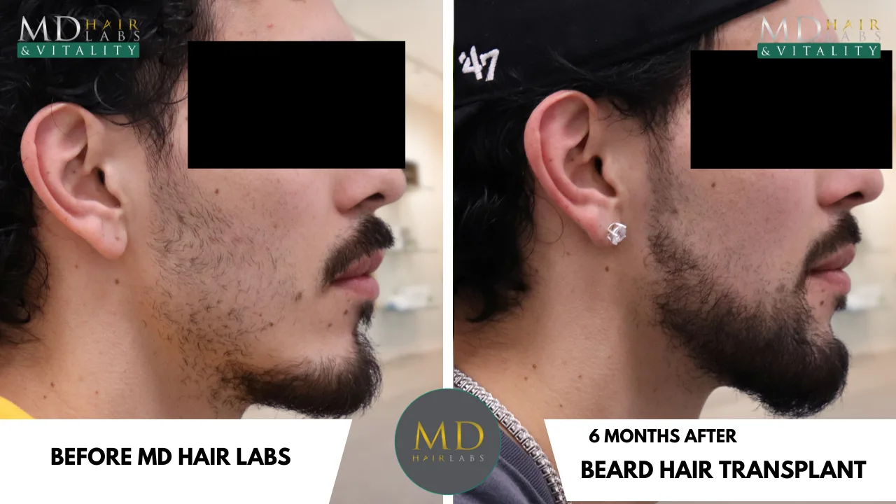 Beard transplant before and after at MD Hair Labs