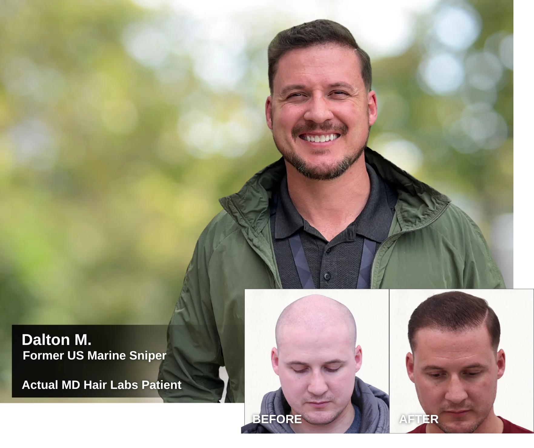 Dalton, former U.S. Marine sniper and MD Hair Labs hair transplant patient — before and after