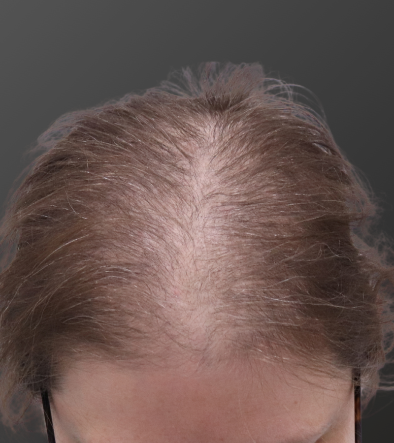 Before — female patient with significant frontal and mid-crown hair loss