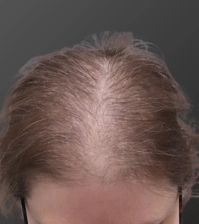 Before — female patient with significant frontal and mid-crown hair loss