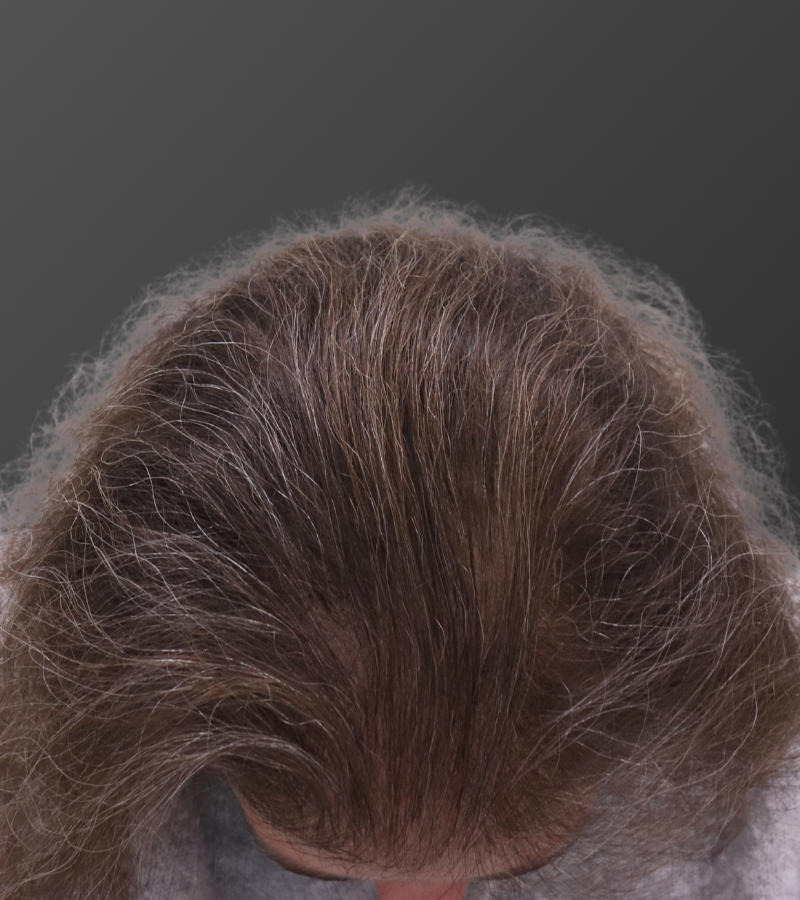 After — restored frontal and mid-crown density following an advanced non-surgical program