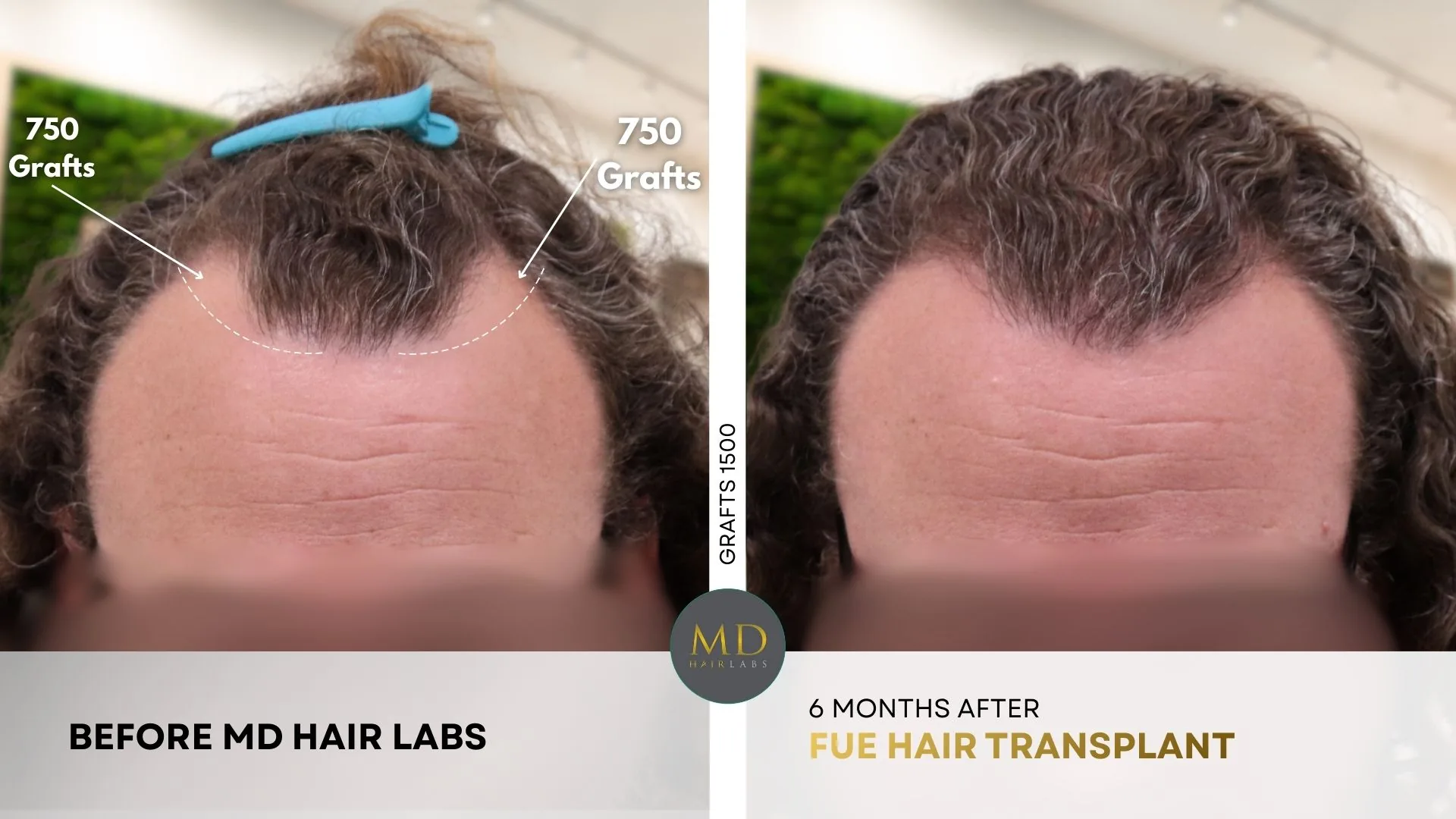 Hairline and crown hair transplant before and after