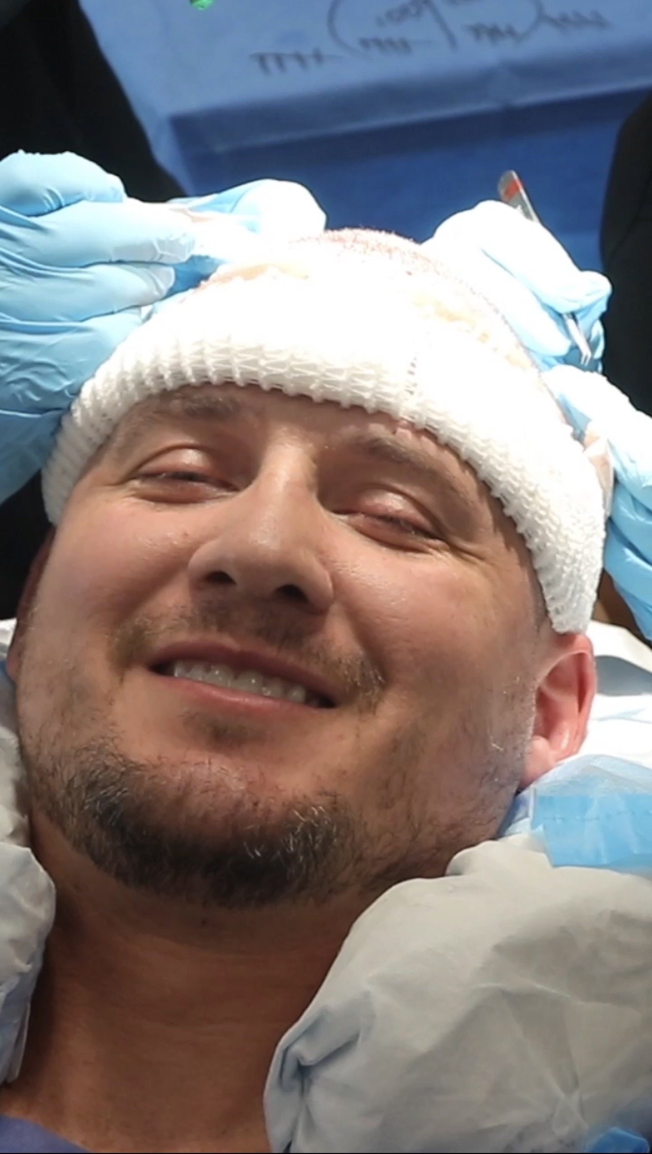 Hair transplant recovery — donor area healed with Devroye WAW-FUE at MD Hair Labs