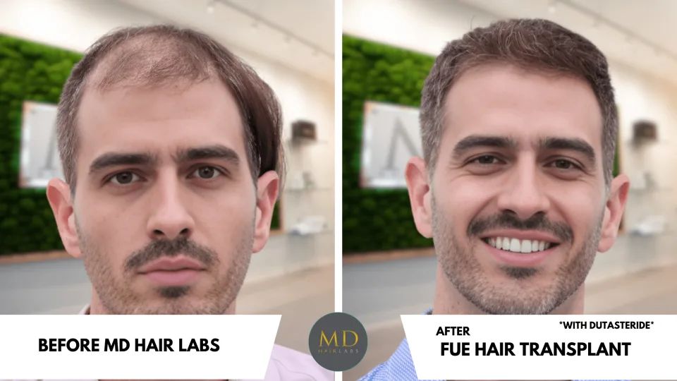 Hair transplant before and after — restored hairline, MD Hair Labs patient