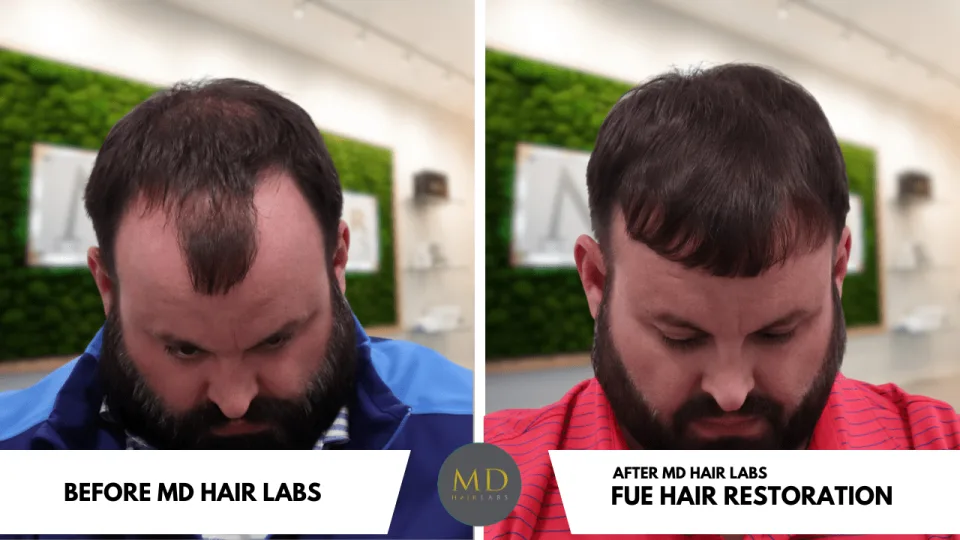 Before and after FUE hair transplant result — MD Hair Labs patient