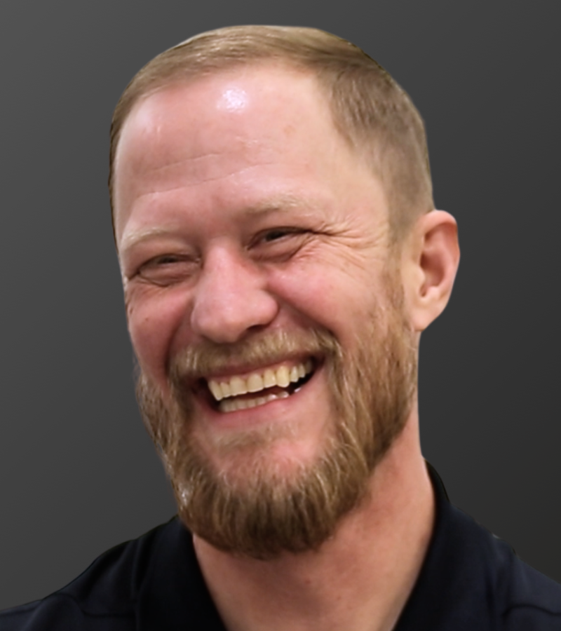 Hair Transplant After - 12 Month Result