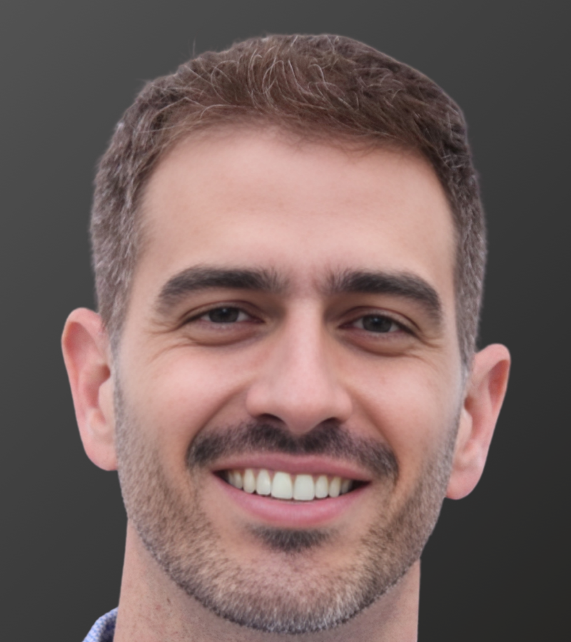 Hair Transplant After - 12 Month