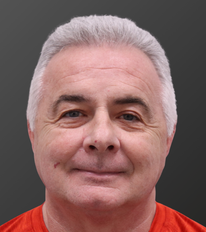 Hair Transplant After - 6 Month