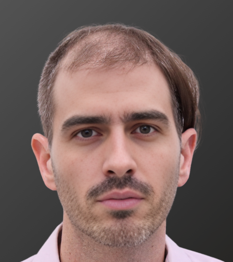 Hair Transplant Before - 12 Month