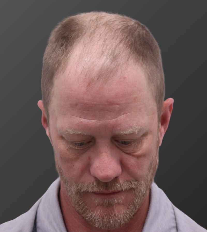 Hair Transplant Before - 12 Month Result