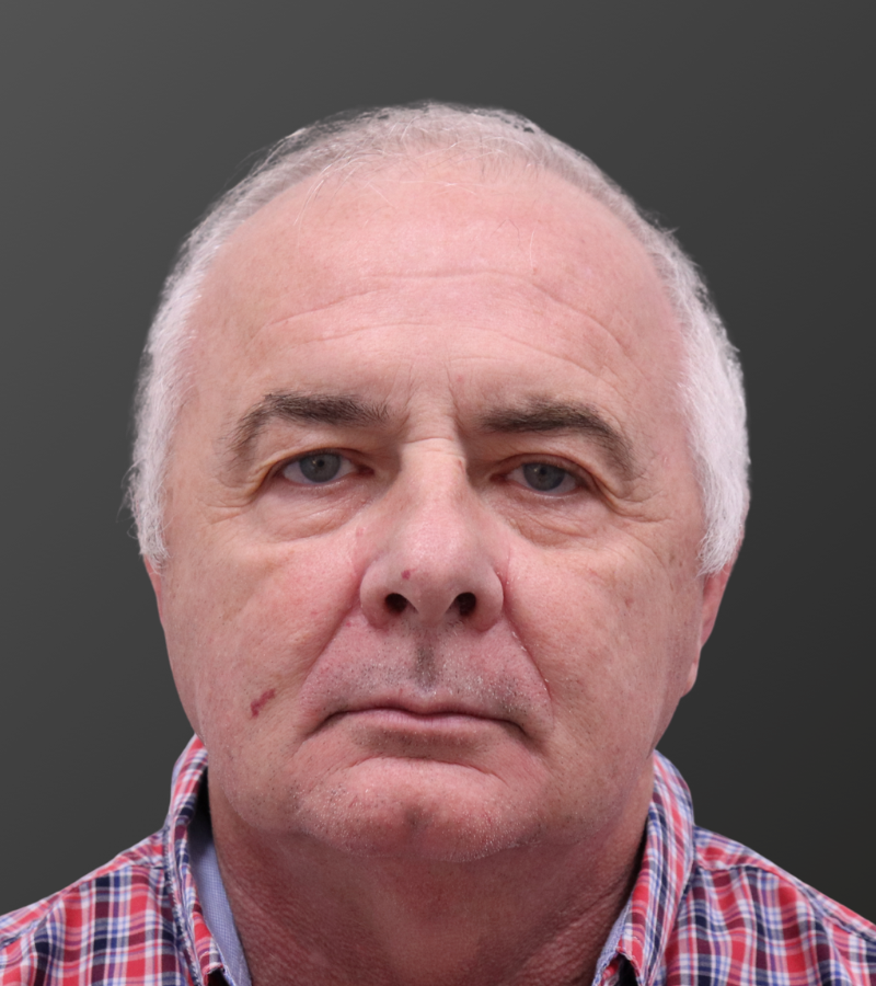 Hair Transplant Before - 6 Month