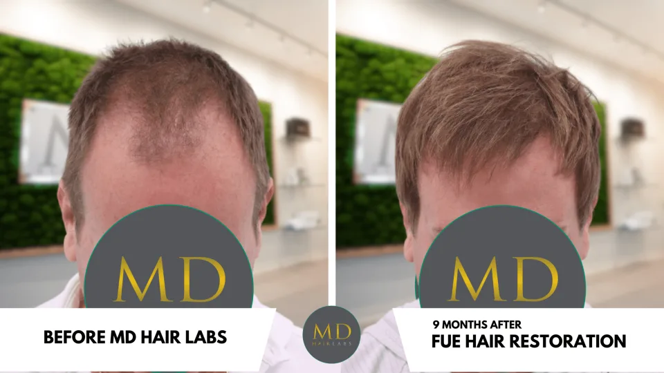 Men’s FUE hair transplant before and after result — MD Hair Labs patient