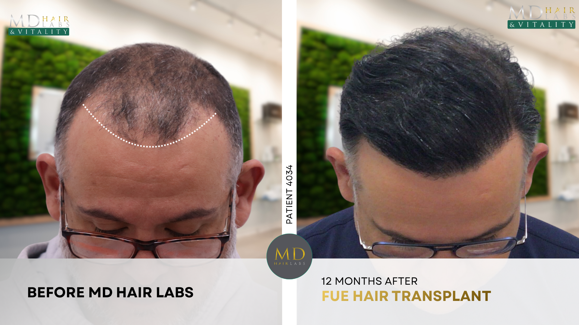 Men's WAW-FUE hair transplant before and after