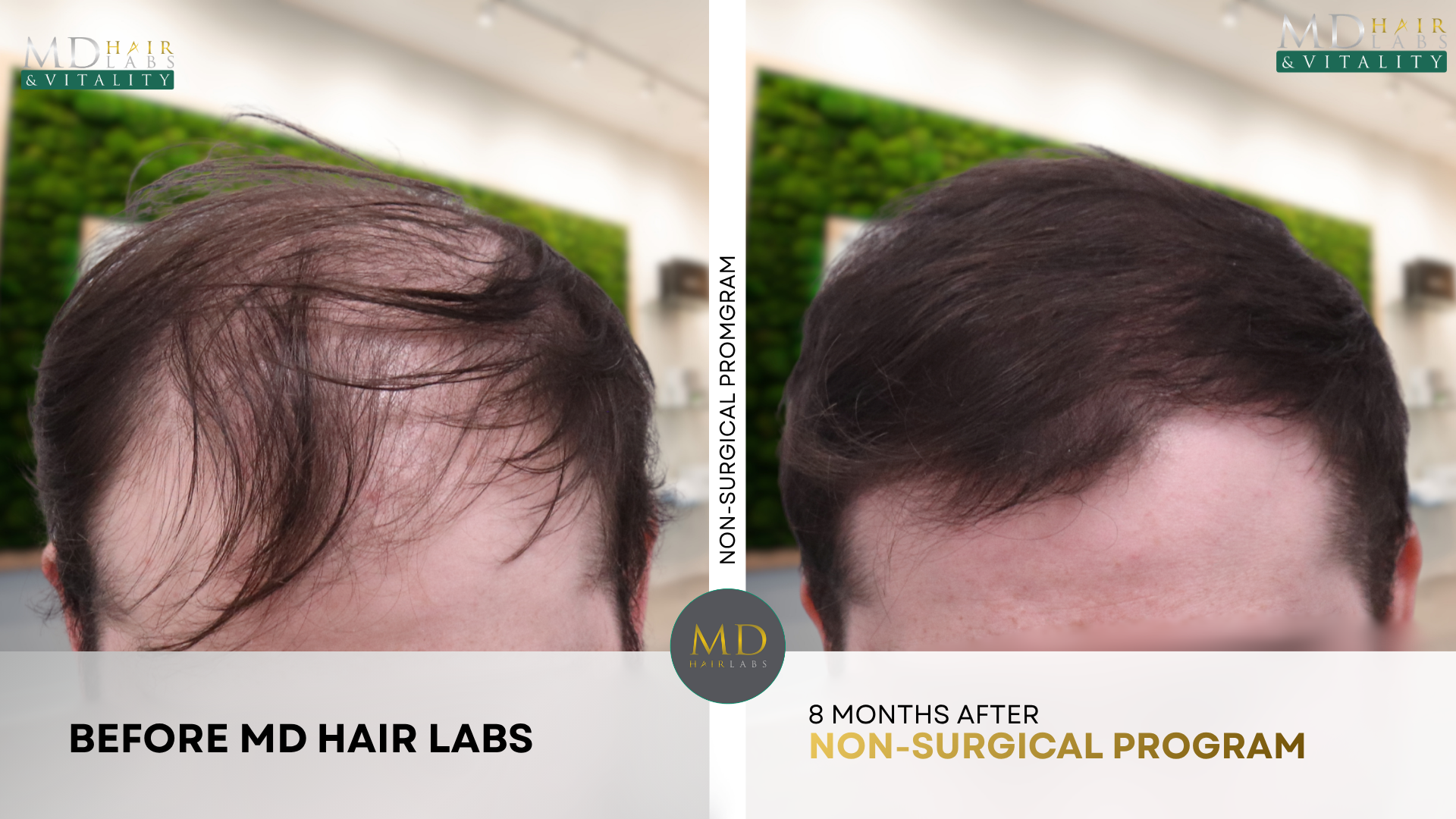 Non-surgical hair loss program before and after result 1 — Patient of MD Hair Labs
