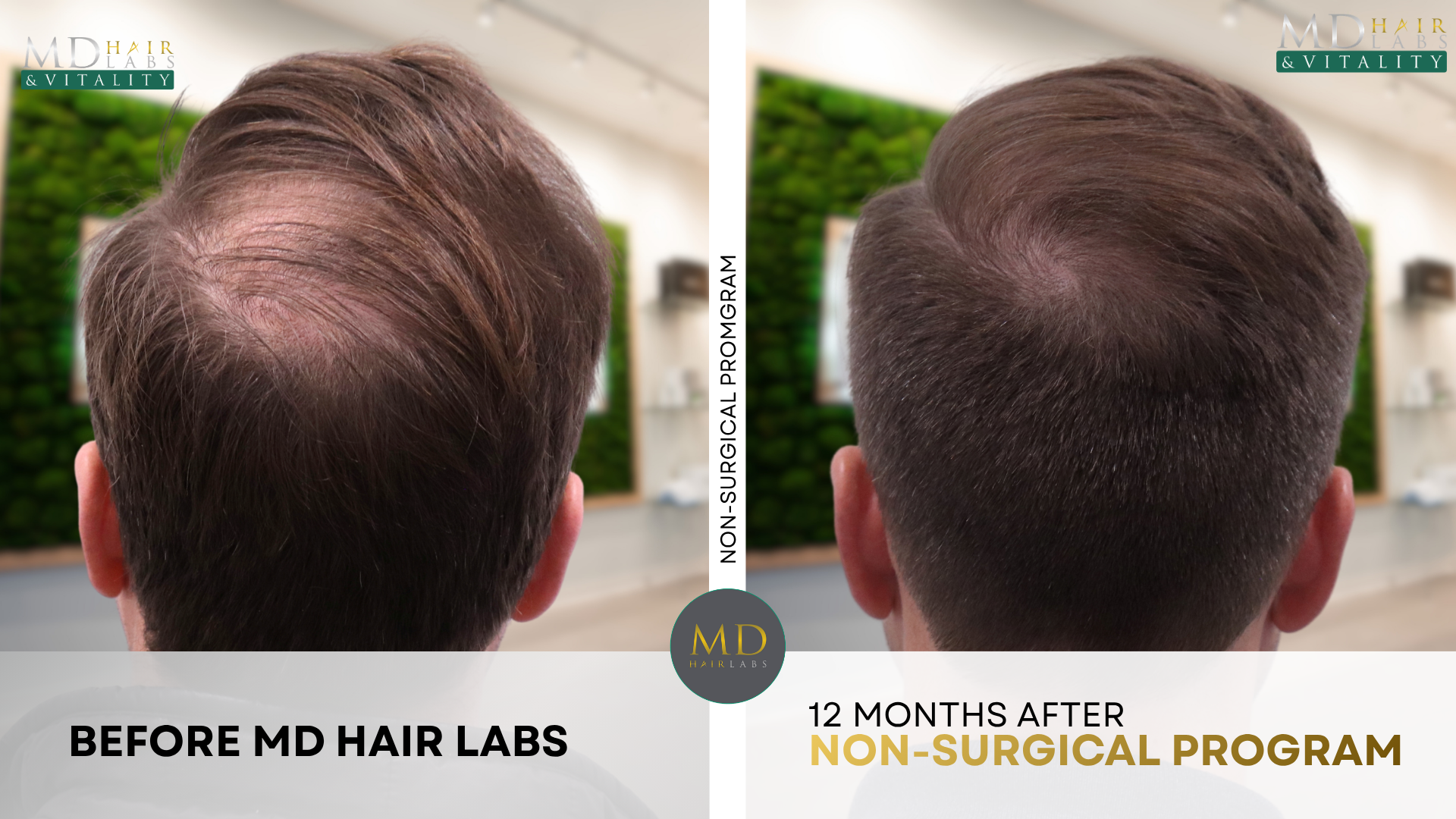 Non-surgical hair loss program before and after result 2 — Patient of MD Hair Labs