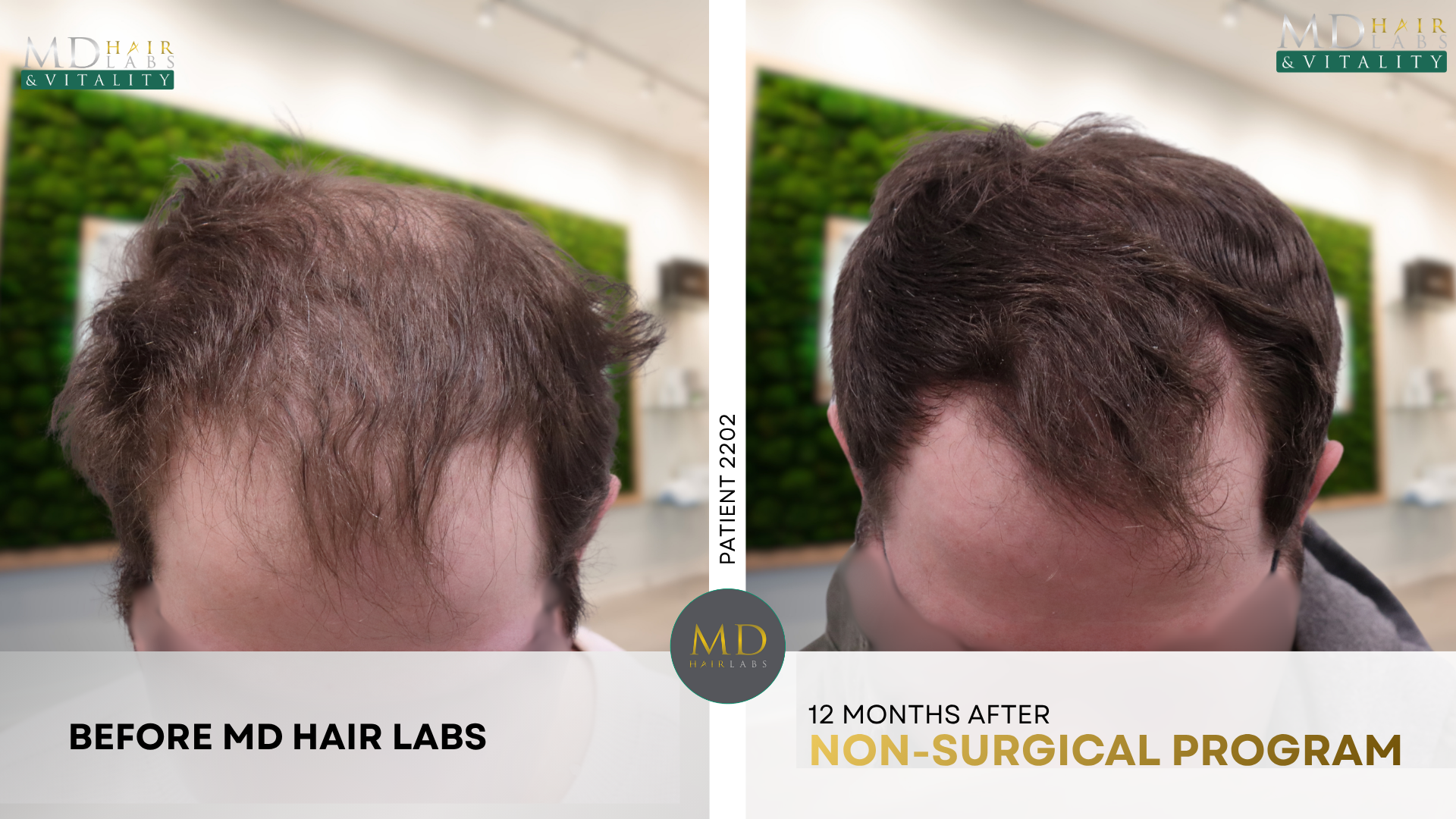 Non-surgical hair loss program before and after result 3 — Patient of MD Hair Labs