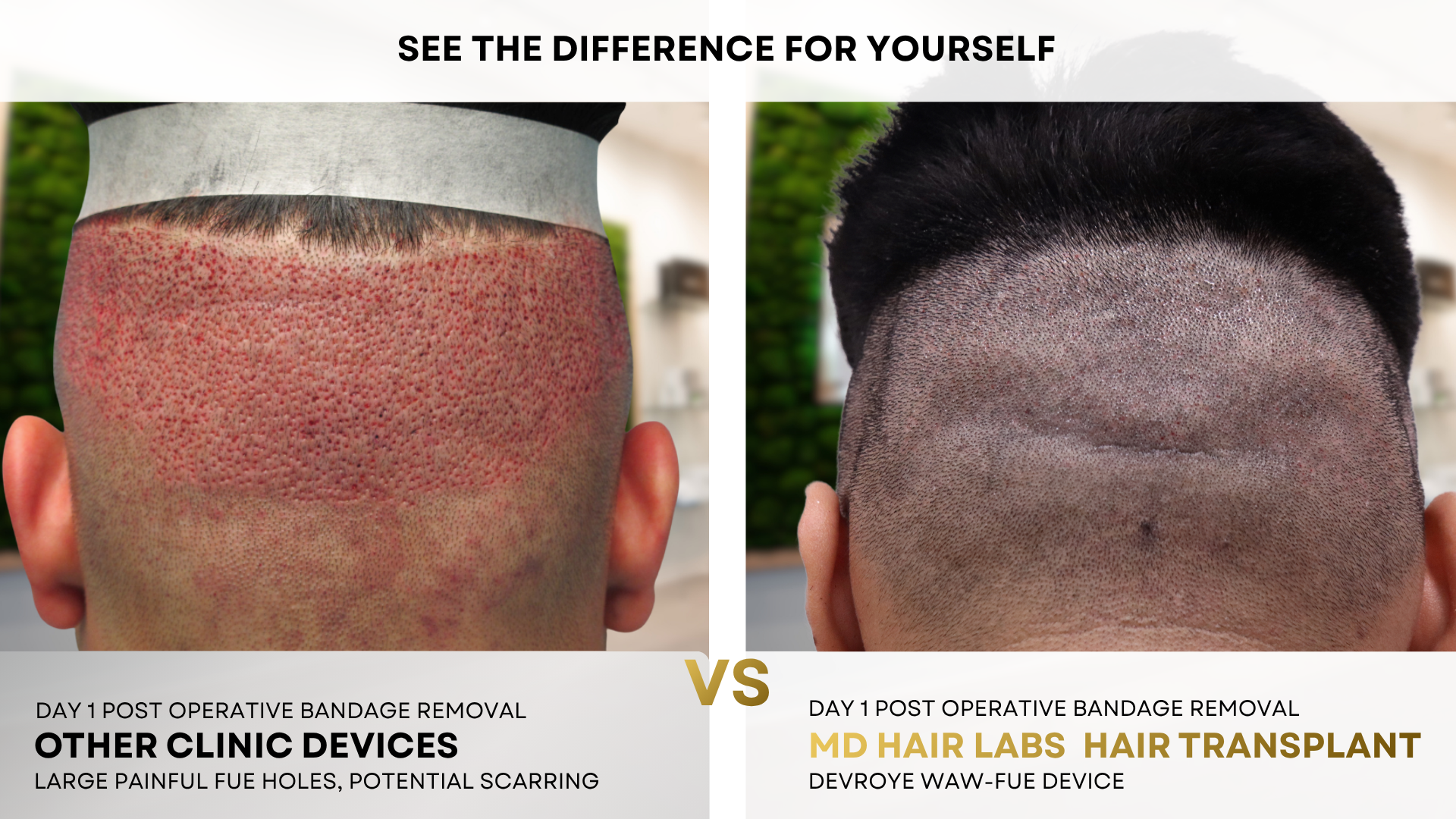 Day 1 donor area comparison: other clinic FUE device vs MD Hair Labs Devroye WAW-FUE — dramatically less redness, trauma and visible holes with the Devroye system