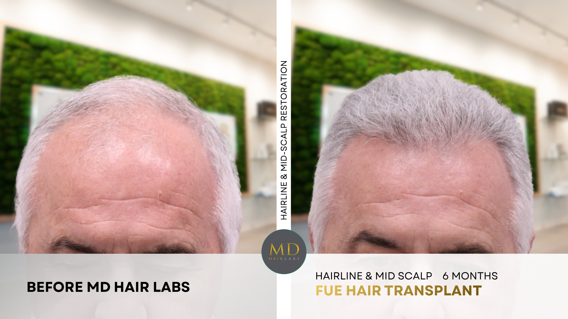 Men's FUE hair transplant results before and after