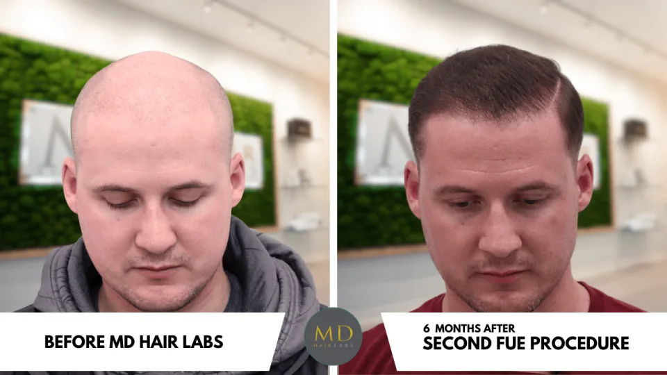 Hair restoration before and after — MD Hair Labs patient