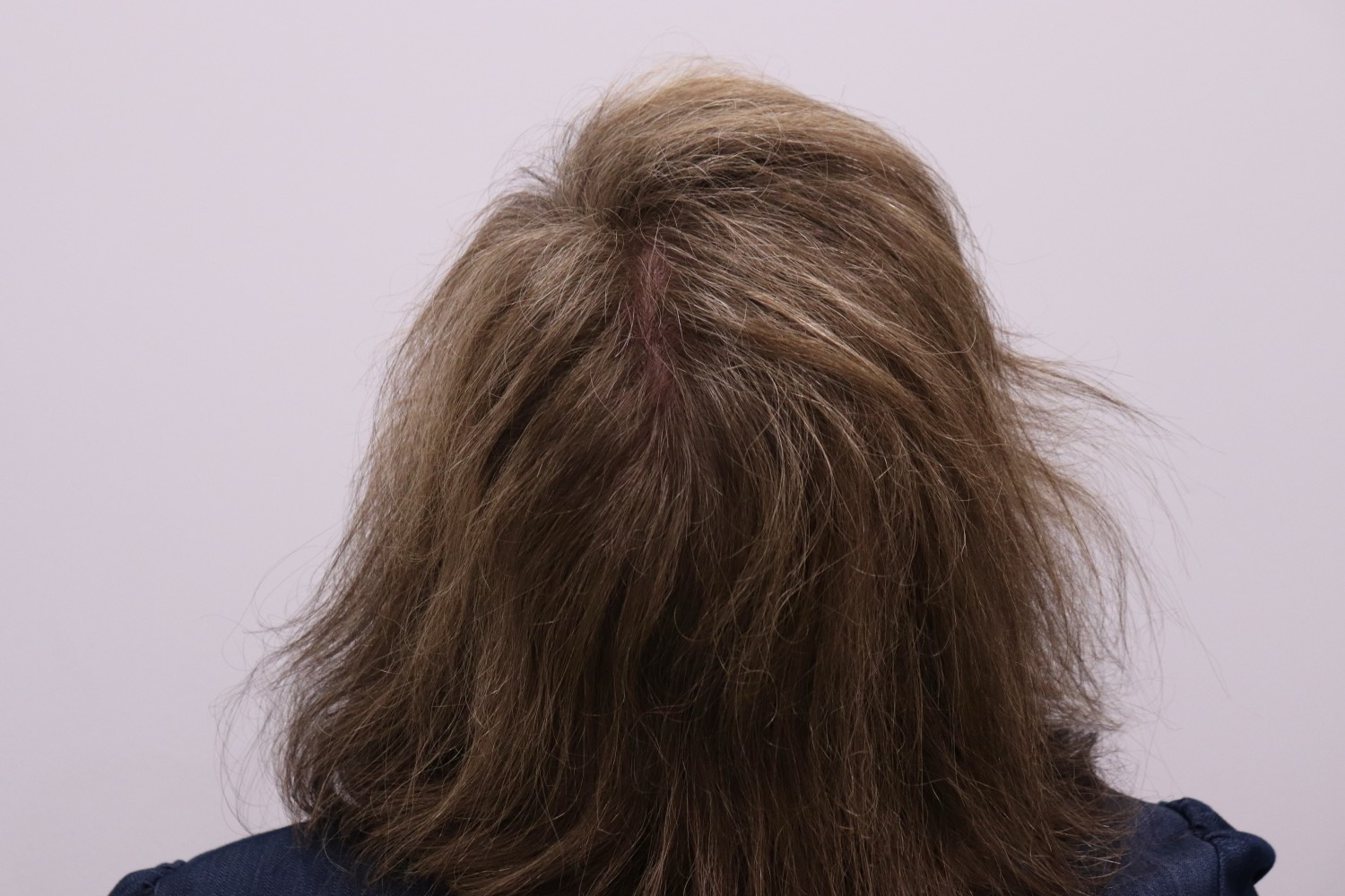 After — thicker, healthier follicles in the crown region after the non-surgical program