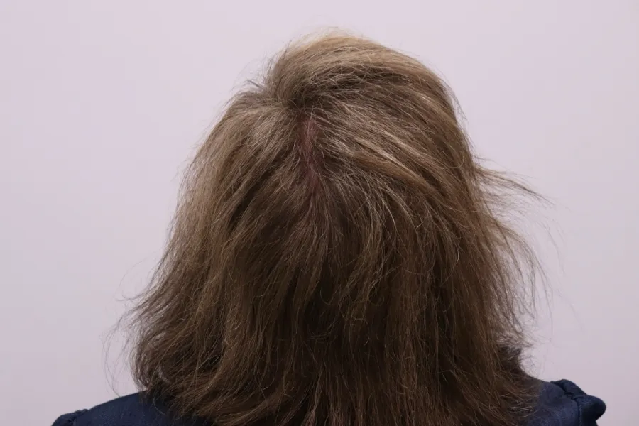 After — thicker, healthier follicles in the crown region after the non-surgical program
