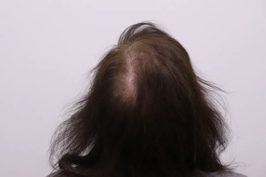 Before — back view showing thin, miniaturized follicles in the crown region