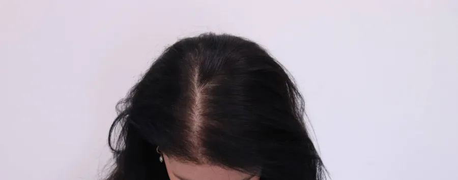 After — restored density across the mid-scalp and crown following the non-surgical program