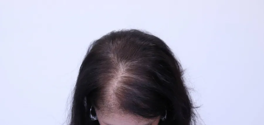 Before — top-down view showing diffuse thinning through the mid-scalp and crown