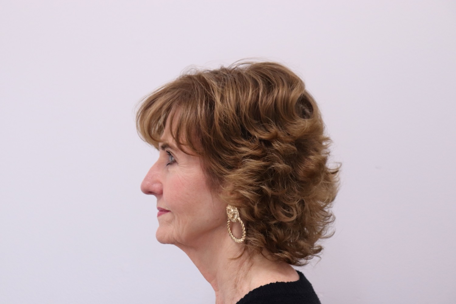 After — fuller hair at the temple and hairline following the non-surgical program