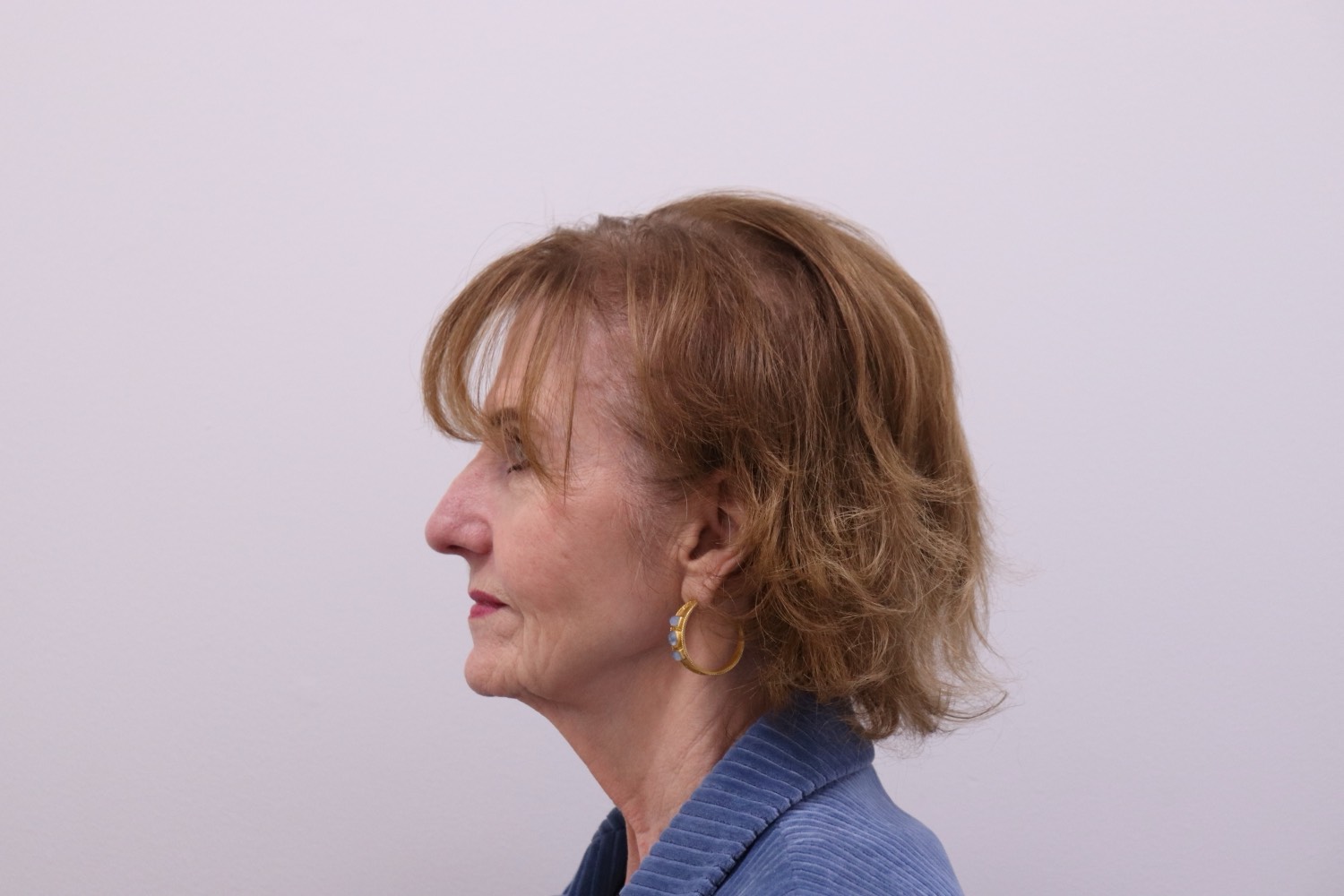 Before — side profile showing thinning at the temple and above the ear